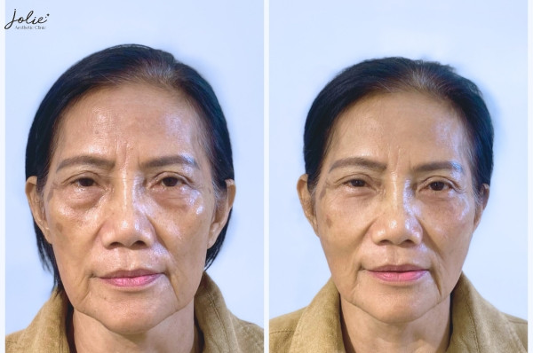 The effects of collagen injections usually appear immediately