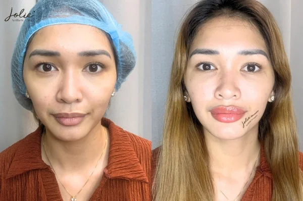 Alternative Solutions to HA Collagen Fillers