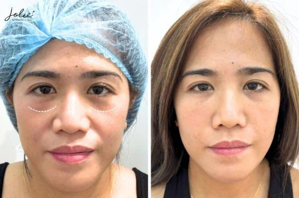 Benefits of permanent collagen filler