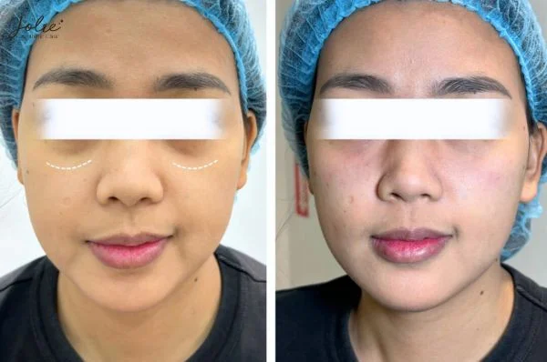 Treatment process at Jolie Clinic