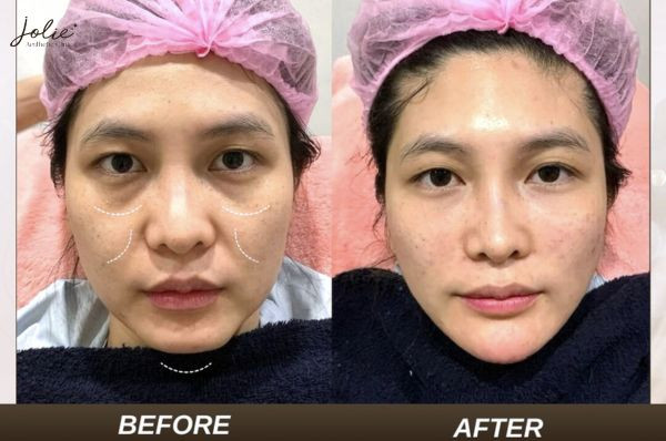 Benefits of HA collagen filler for temple enhancement