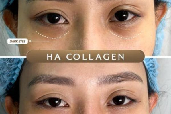 Removing dark circles with HA collagen