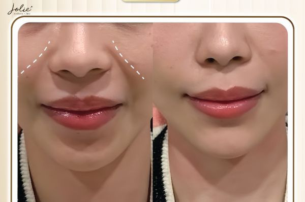 Results after smoothing nasolabial folds