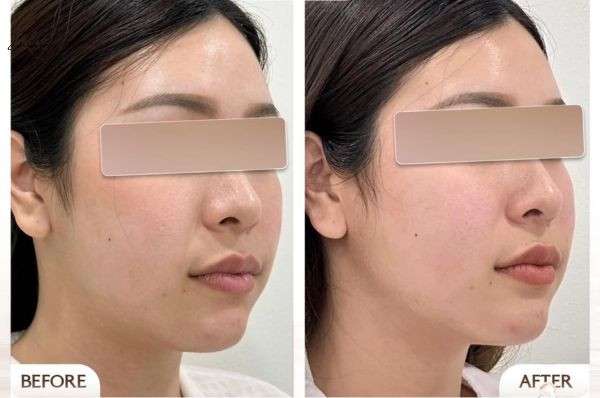 Results after effective chin fat reduction