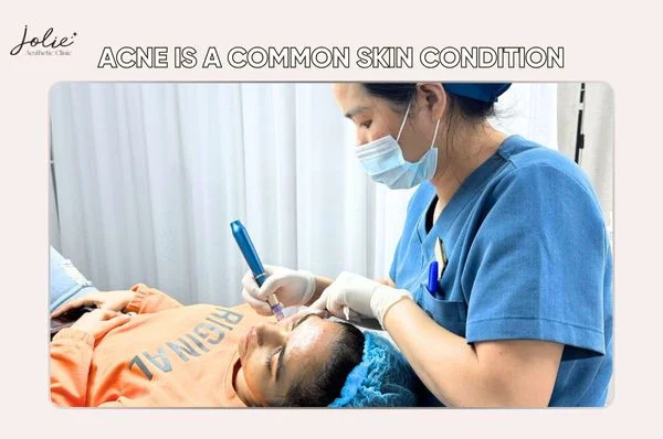 Acne is a common skin condition in teenagers and adults