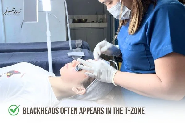 Blackheads often appears in the T-zone of the face