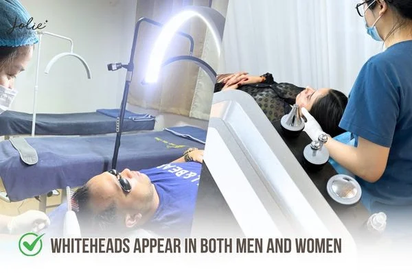 Whiteheads often appear in both men and women