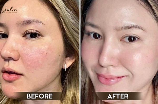 Treatment results at Jolie Clinic for dry skin