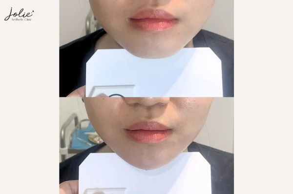 Why Choose Jolie Clinic for Aesthetic Dermal Filler Injections?