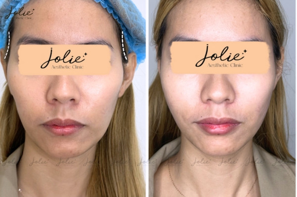 Botox Injections for a Younger-Looking Forehead