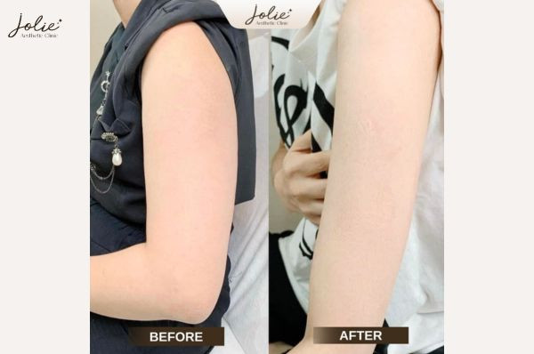 Benefits of Arm Slimming Injections