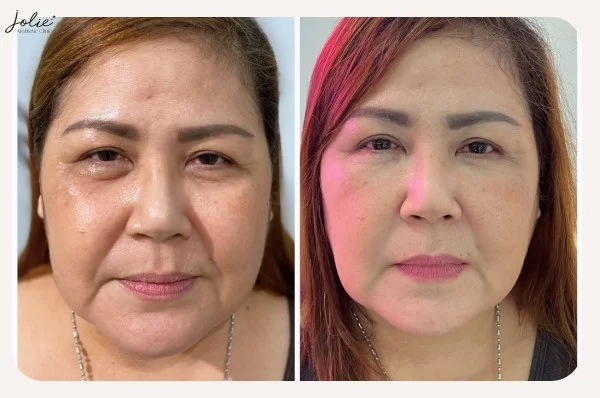 Let's find out what arm fat reduction injection is?