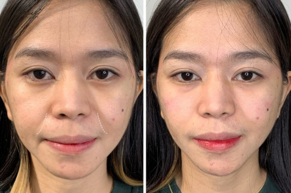 Results before and after filling smile lines at Jolie Aesthetic Clinic