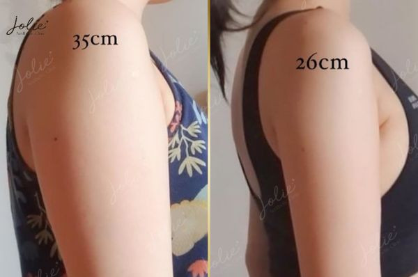 Common cases where Botox injections for arms are used