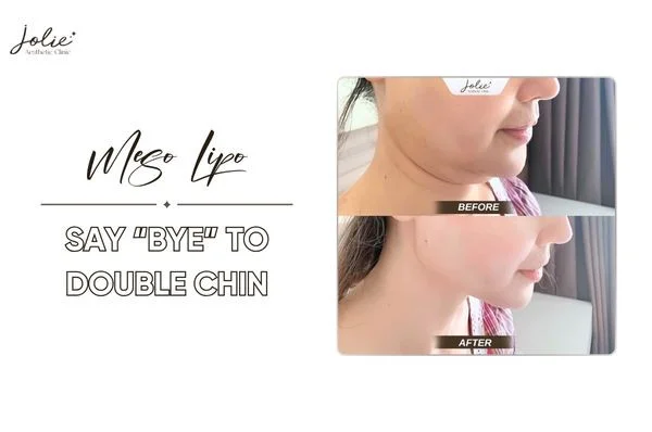 Meso Lipo - Say “bye” to double chin