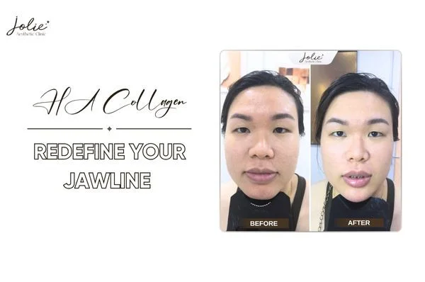 HA Collagen - Redefine your jawline naturally