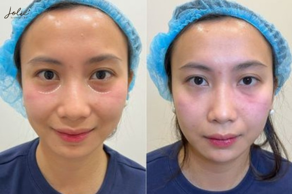 Plumping the Under-Eye Area for Rejuvenation