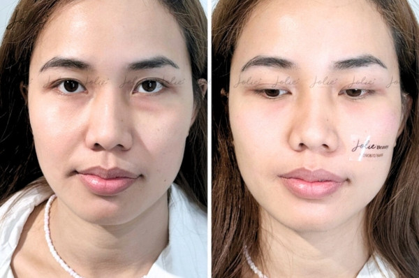 Verifying the Safety of Beauty Treatments with Fillers