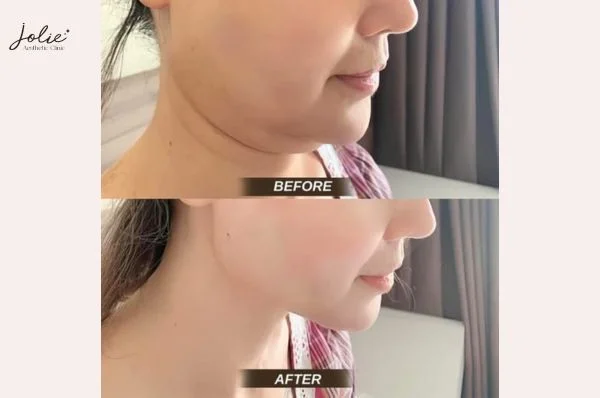 Double chin injections are designed to target perfect look