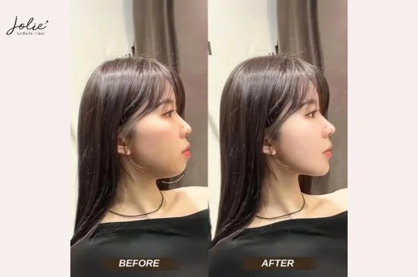 Double Chin Slimming Injections: Are they right for you?