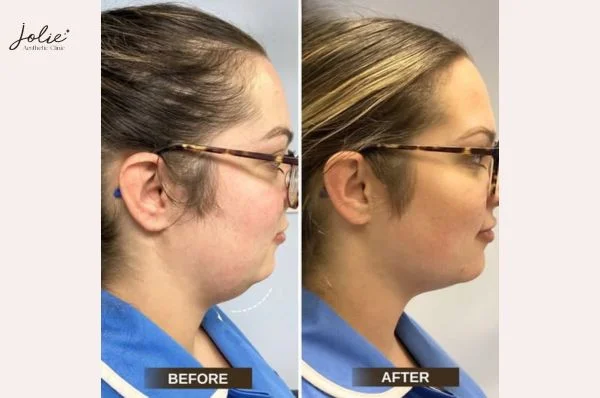 Explore the double chin injections procedure at Jolie Clinic