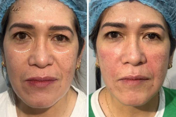 What are eye filler injections?
