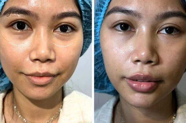 Benefits of eye filler injections