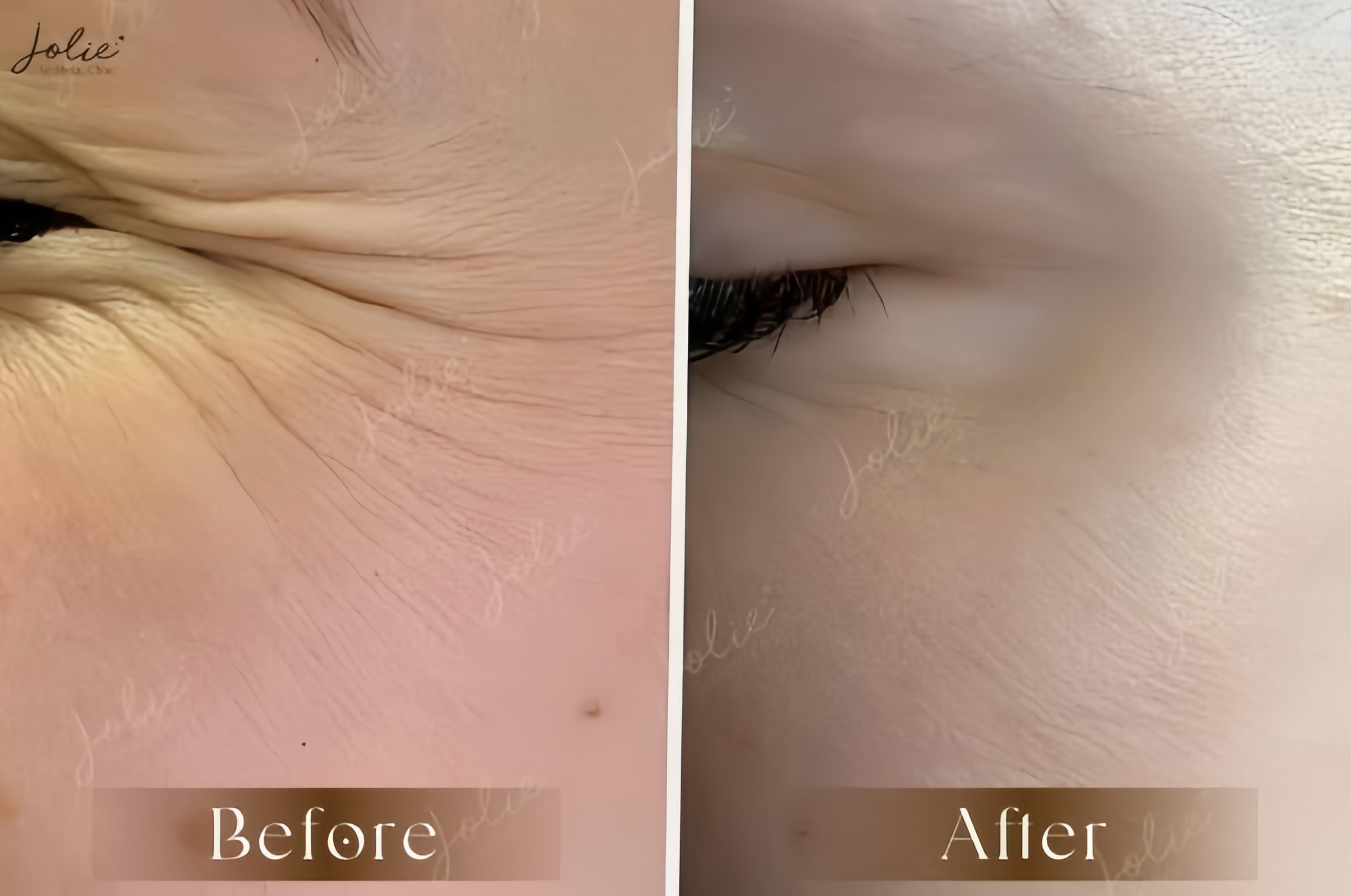 Results after a period of filler injections for your reference