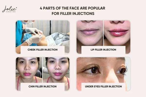 4 parts of the face are popular for filler injections