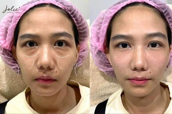 What are the filler injections for face lift?