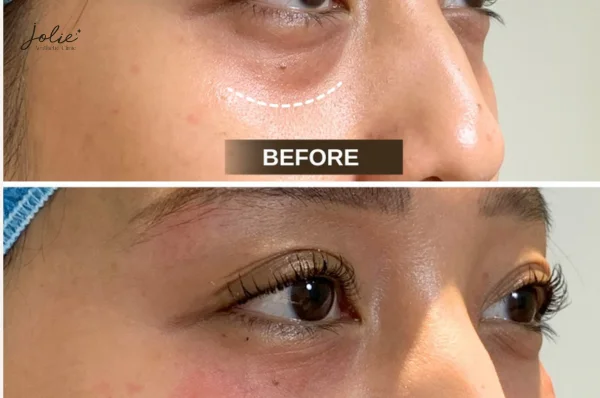 How filler injections create a face lift effect