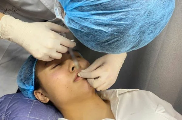 Instant gratification - One of the benefits of filler injections for face lifts