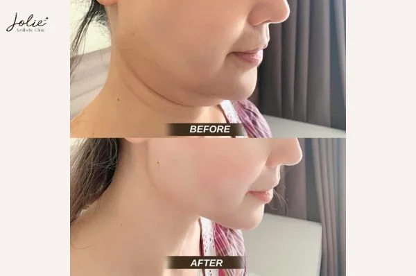 Natural Aging can be a root cause of jowl fat