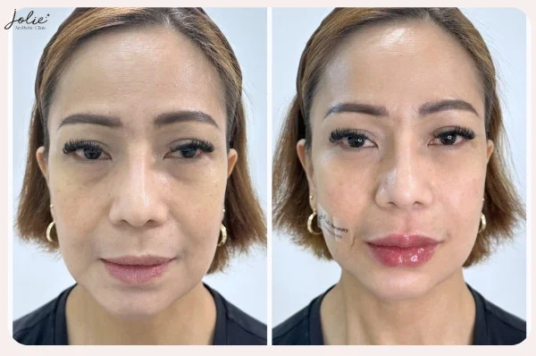 Learn about scars with Jolie Clinic