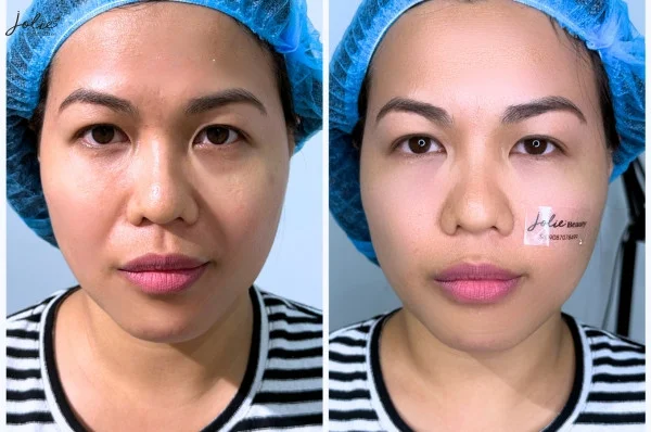What causes scar formation?