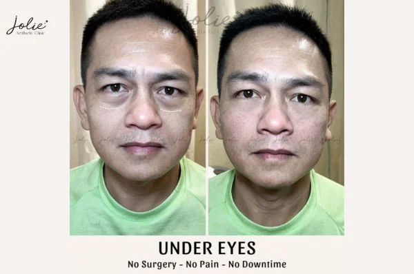 Filler injections under eyes are a popular cosmetic treatment