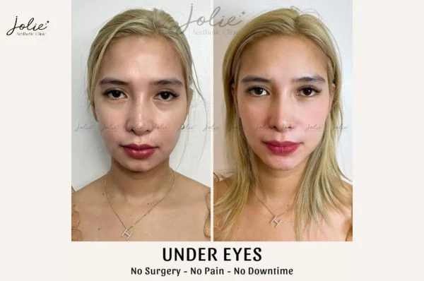Filler injections can help rejuvenate the skin around the eyes