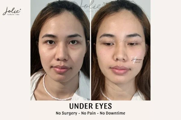 Filler injections for under eyes for beautiful and captivating eyes