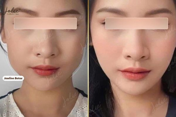 Restoring facial volume with filler injections for the face