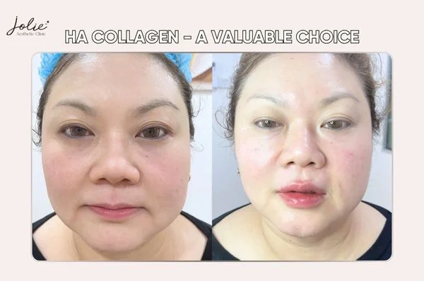 HA Collagen in Malaysia has become a valuable choice