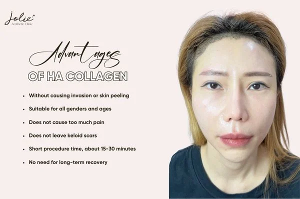 Advantages of HA collagen injection