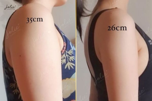 Surprising results after arm slimming injections