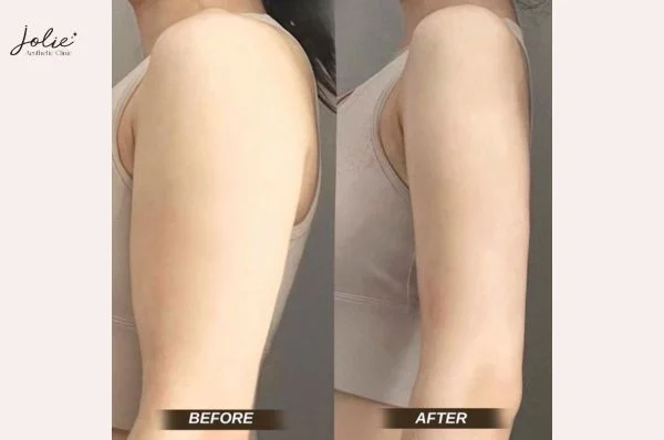The results depend on the injection area and individual body type