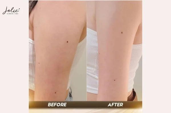 This injections are a non-invasive method for addressing excess fat