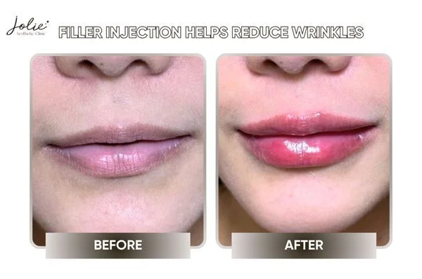 Filler injection in vermilion lip helps reduce wrinkles