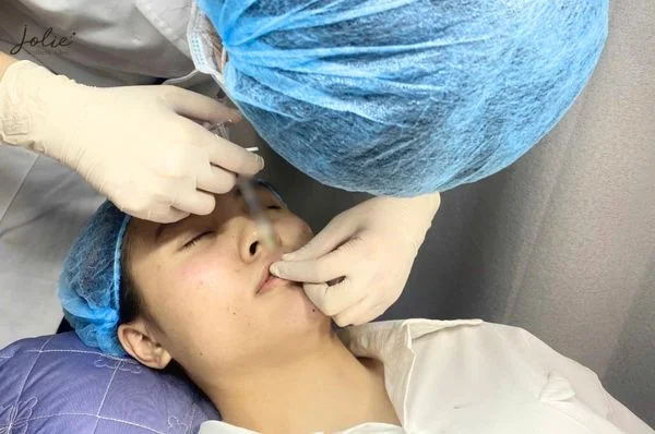The lip filler injection process only takes about 15-30 minutes