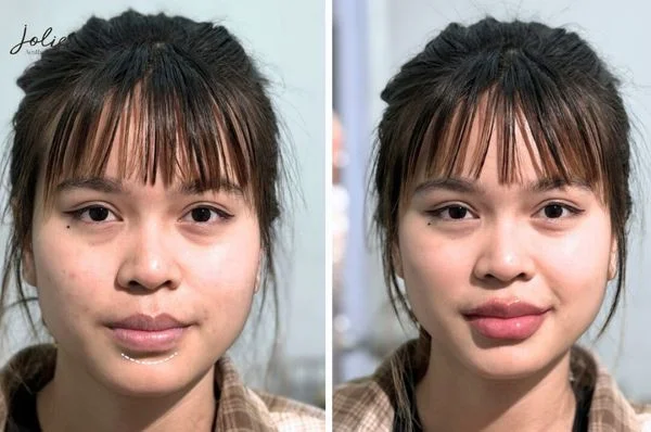 Lip fillers create a balanced facial appearance
