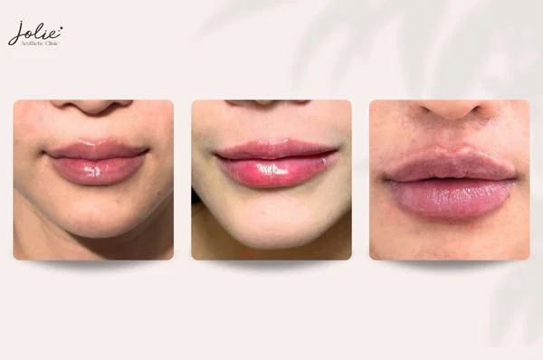 There are many hot trend lip filler injection shapes at Jolie Clinic