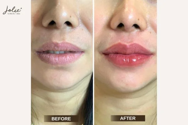 What to avoid during lip injections after care 