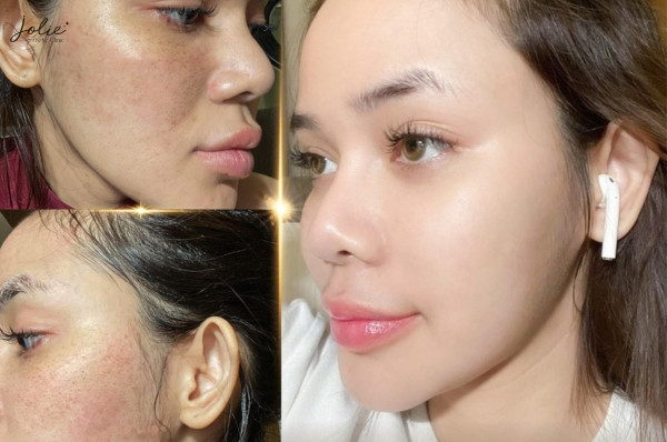 Results of Melasma Treatment at Jolie Clinic